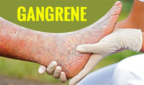 Gangrene Causes Signs And Symptoms Diagnosis And 51 Off