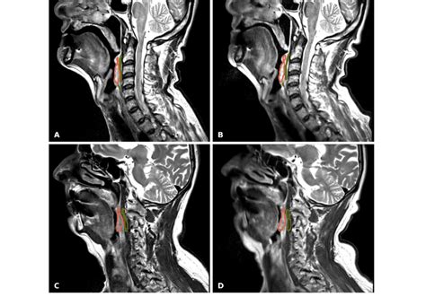 T2w Mri Using Turbo Spin Echo Tse Technique Of Two Patients A B