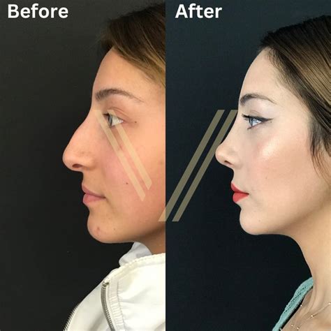 Nose Job Rhinoplasty In Istanbul Turkey Procedure Prices