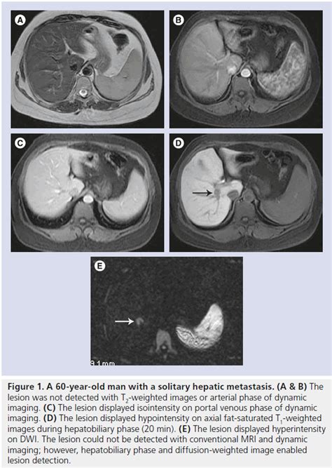 Gadoxetic Acid Enhanced Mri A Method For The Detection Of Hepatic