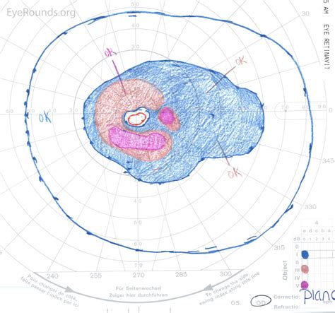 Bull S Eye Maculopathy Due To Hydroxychloroquine Toxicity