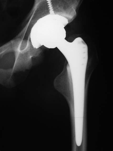 Delayed Transient Sciatic Nerve Palsy After Primary Cementless Hip