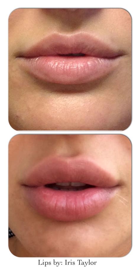 List Of Best Lip Fillers Near Me Ideas