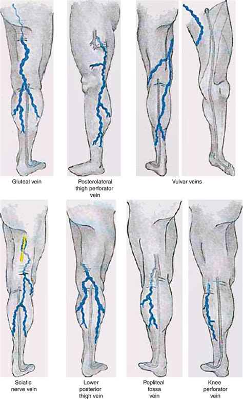 Venous Reflux Worksheet