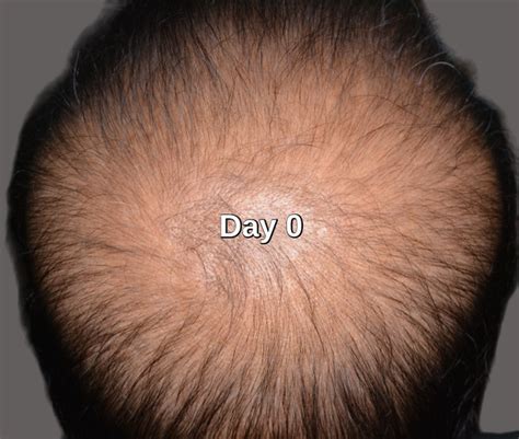 Stem Cell Hair Loss Treatment Clinic Lahore Pakistan Call Us Now