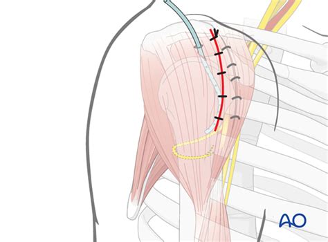 Anterolateral Approach To The Proximal Humerus