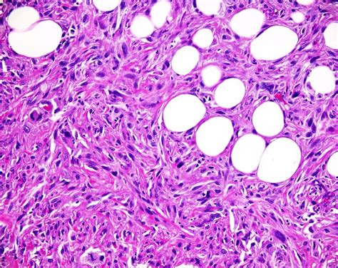 Undifferentiated Pleomorphic Sarcoma Mfh Sarcoma Pathology