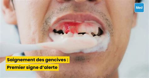 Saignement des gencives Premier signe d alerte Magazine Médical