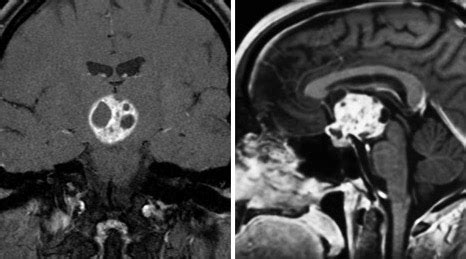 Diagnosing Craniopharyngioma Aaron Cohen Gadol MD