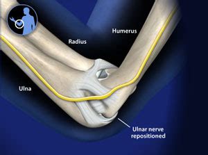 Treating Ulnar nerve transposition in Plano, Frisco, McKinney and Allen ...