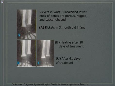 Understanding Rickets Typesdiagnosisprevention And Treatment Drsande