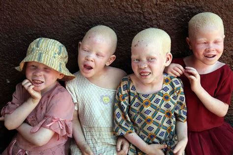 La Persecución De Los Albinos En Tanzania Marcianos