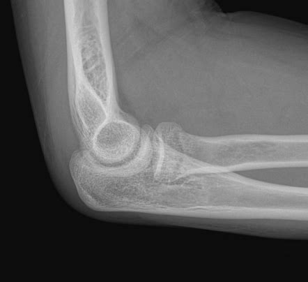 Radial Neck Fracture Radiology Case Radiopaedia Org