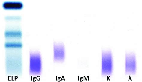 Serum Protein Electrophoresis And Immunofixation Test at Kathy Esquivel ...