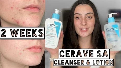 TESTING CERAVE SA CLEANSER LOTION ON MY DRY ACNE SKIN FOR 2 WEEKS