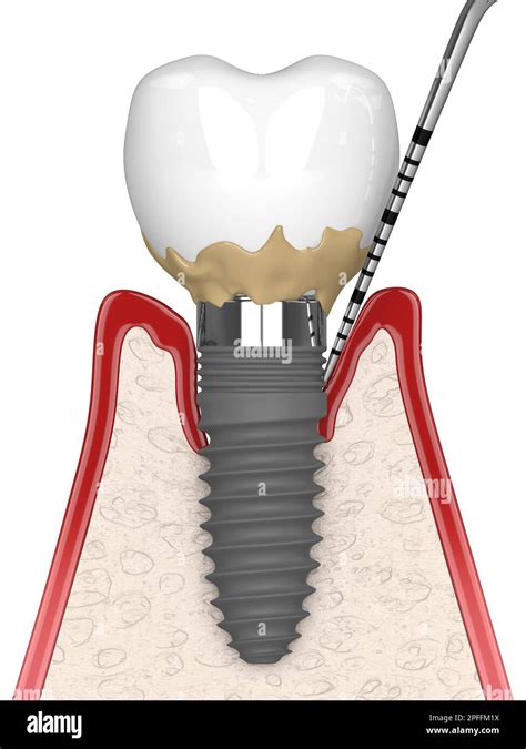 3d Render Of Human Gums Cross Section With Peri Implantitis Disease And