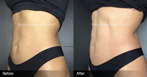 Before and After | Body Sculpting Clinic