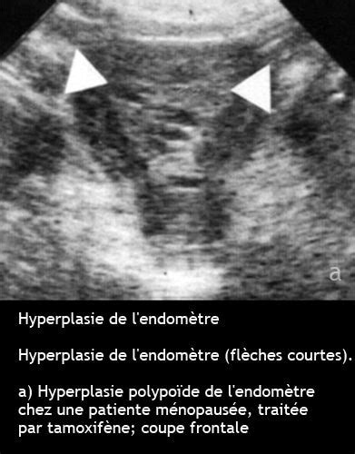 Anomalies De La Cavit Ut Rine Dr Kara Zaitri M A