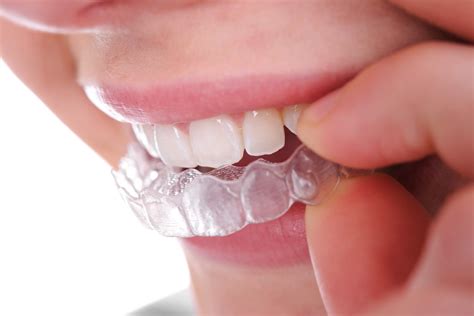 Teeth Alignment Calgary Invisalign Braces Impact Orthodontics