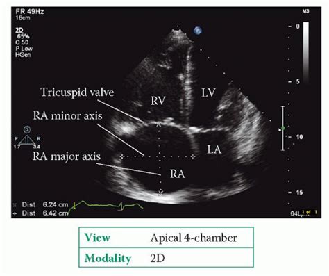 The Right Heart | Thoracic Key