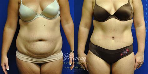 What Results Can You Expect From A Tummy Tuck Before And After Photos