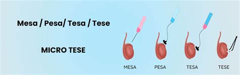 Micro Tese Tesa Mesa Pisa Pesa A4 Fertility In Chennai