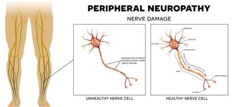 Peripheral Neuropathy Definition Types And Treatment Options Makai