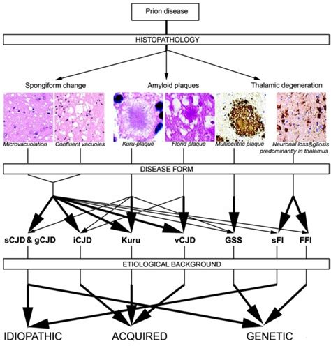 Overview Of The Spectrum Of Human Prion Diseases Microphotograph Of