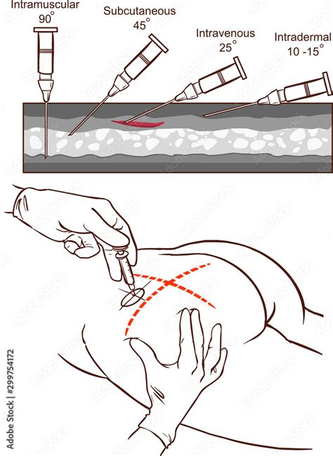 Vetor De Intramuscular Injection Vector Illustration And Comparison Of