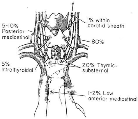 Normal And Ectopic Locations Of Parathyroid Glands Reproduced From