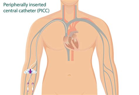 Picc Catheter