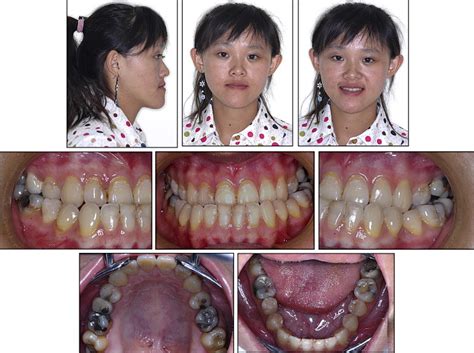 Correction Of Skeletal Class Iii Malocclusion With Clockwise Rotation