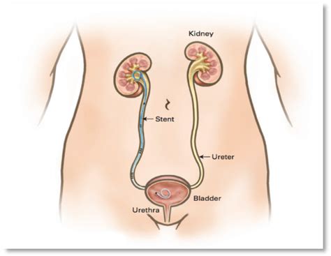 Cateter Doble J Clinica Urosalud