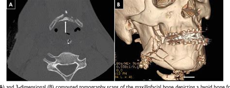 Figure 1 From Management Of Hyoid Bone Fractures Semantic Scholar