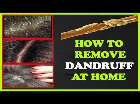 How To Remove Dandruff From Hair Permanently At Home YouTube