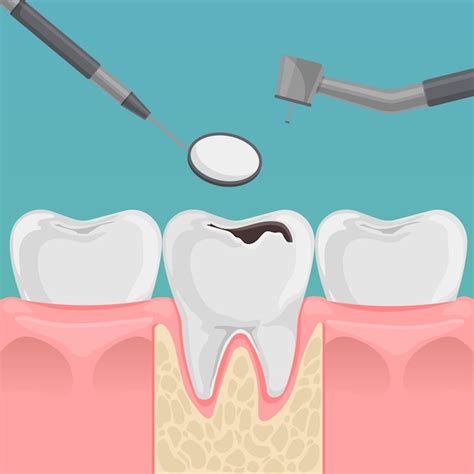 Dientes Con Caries En Las Encías Diente Con Concepto De Tratamiento De Agujeros De Caries