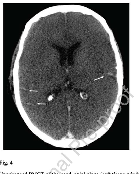 Figure 4 From Postmortem Radiological Imaging Of Natural Causes Of