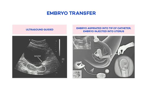 Embryo Transfer Diagram Fertility Tasmania