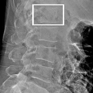 AP Lumbar Spine Anatomy