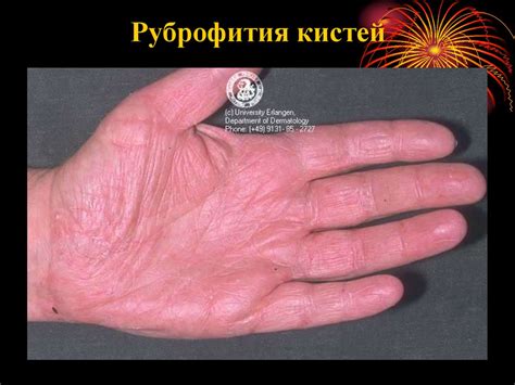Микозы стоп - презентация онлайн