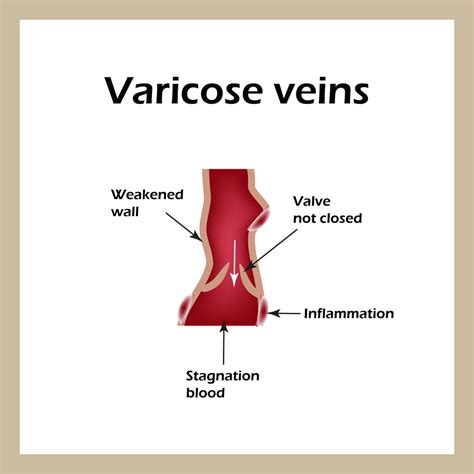 Venous Leg Ulcers: Causes and Symptoms - The Vein Center of Maryland