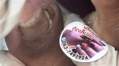 Ep6970 Ingrown Toenail Removal 👣 ดูดีขึ้นไหมคะ 😄 Clip From Thailand