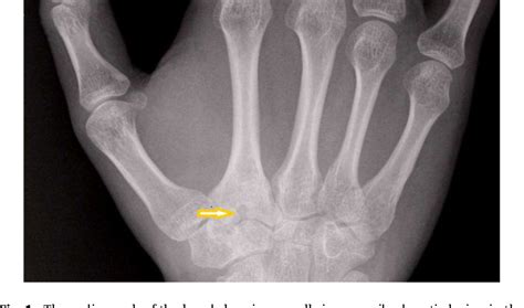 Figure 4 From Osteoid Osteoma As An Unusual Cause Of Wrist Pain A