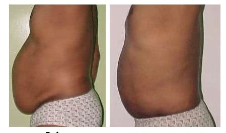 Lipolysis Injection Treatment in Dubai - Laser Skin Care Clinic Dubai