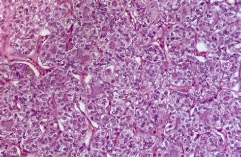 Cytological And Molecular Diagnosis Of Solid Variant Of Papillary