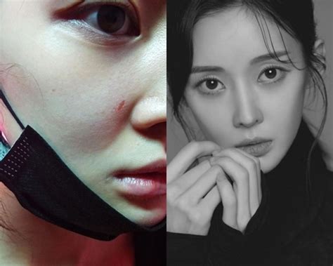 이혼 티아라 아름 前 남편에 맞아 코뼈 휘고 피멍 들어사진 공개전문 네이트 연예