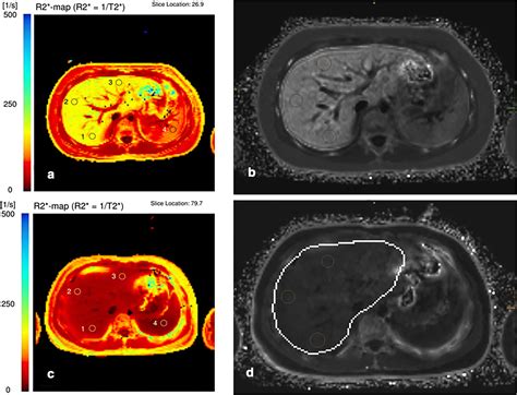 Practical Guide To Quantification Of Hepatic Iron With Mri Springerlink