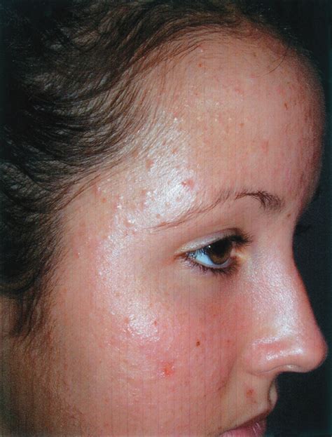 Pityrosporum Folliculitis Acne Jama Pediatrics The Jama Network