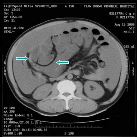 Ct Scan Of Abdomen Showing Pseudomyxoma Peritonei With Mucin Septations Download Scientific