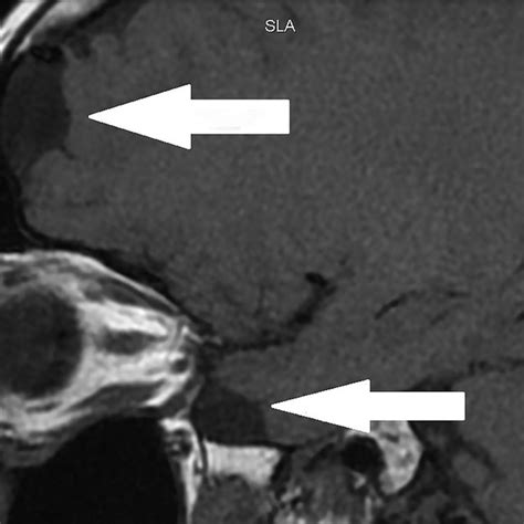 Sagittal T1 Weighted Image Showing The Arachnoid Cyst On The Right